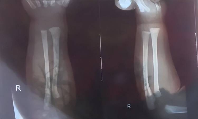 广西一男婴在月子中心被照料20天：身上2处骨折<strong></p>
<p>虚拟币残币</strong>，育婴室监控无法查看