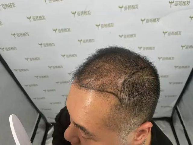 “还能反光<strong></p>
<p>虚拟焦耳币</strong>！”长沙男子植发近9月称后脑勺“像狗啃过”