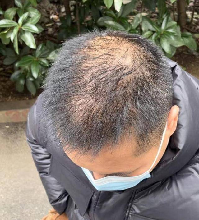 “还能反光<strong></p>
<p>虚拟焦耳币</strong>！”长沙男子植发近9月称后脑勺“像狗啃过”