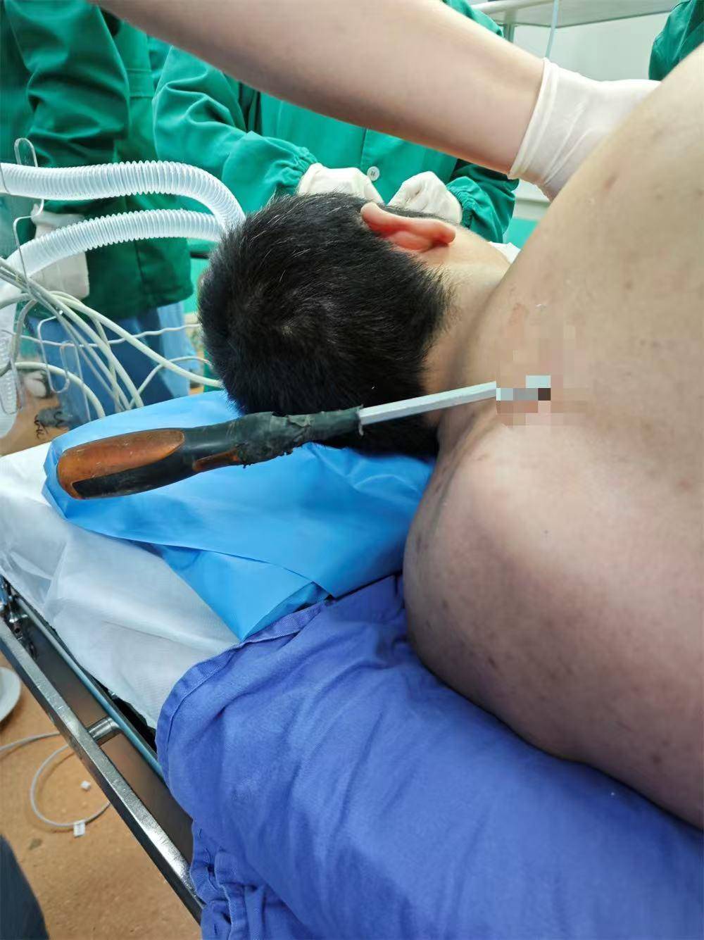 20米高空掉落螺丝刀直插男子胸腔<strong></p>
<p>实盘虚拟币</strong>！医生：不要自行拔除