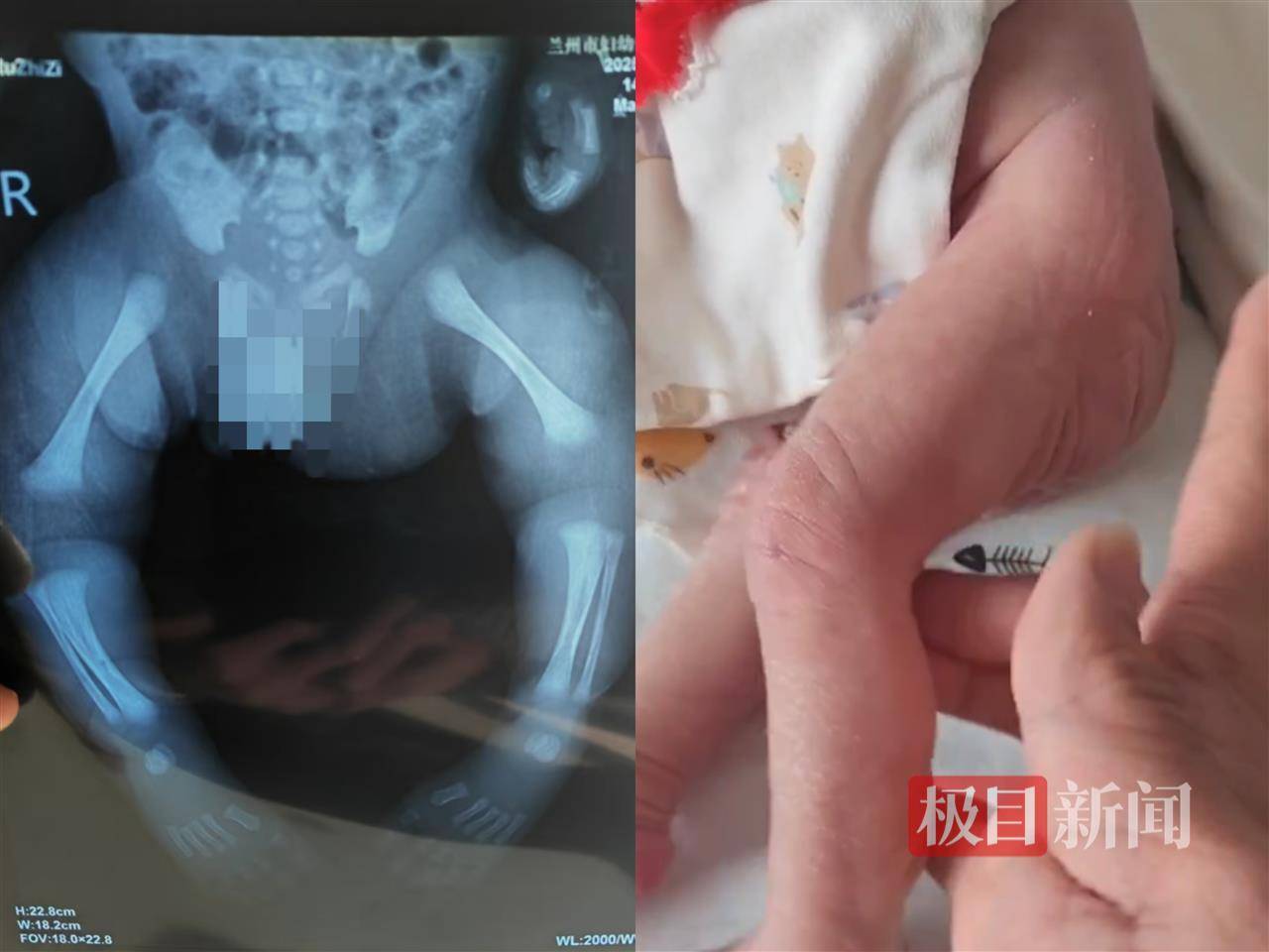 二胎出生查出先天性病症或落下残疾<strong></p>
<p>卡通虚拟币</strong>，残疾父母称医院产检漏检、未尽告知义务，医院及医调委回应