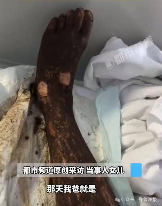 安徽宣城一男子走路玩手机<strong></p>
<p>四项虚拟币</strong>,一脚踩中打架的竹叶青和五步蛇,被俩毒蛇咬3口!医院:暂无生命危险,正在治疗