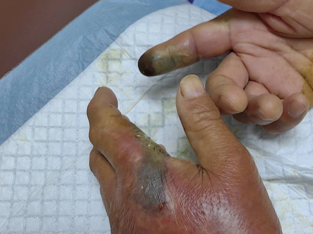 眼镜王蛇咬伤老人<strong></p>
<p>比特币换虚拟货币</strong>,家属拖两米多长的“凶手”冲进医院!“拎蛇就医”可取吗?