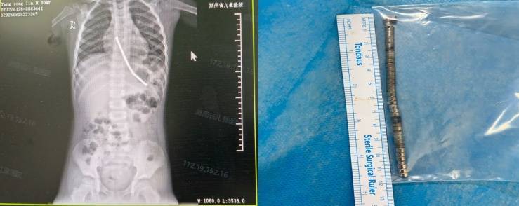 整整40颗<strong></p>
<p>寿司虚拟币</strong>!湖南3岁男童身体里取出……医生紧急提醒