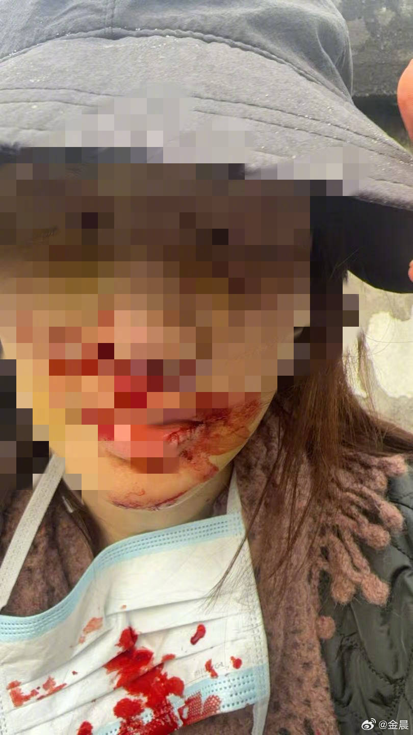 警方发布警情通报后<strong></p>
<p>新数字货币</strong>,金晨晒脸部受伤照片并发文道歉